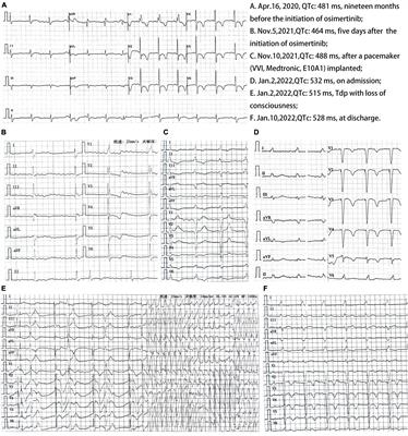 Case Report: Torsade de Pointes Induced by the Third-Generation Epidermal Growth Factor Receptor–Tyrosine Kinase Inhibitor Osimertinib Combined With Litsea Cubeba